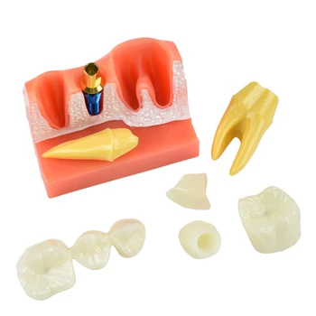 Zubné Endodontic Zuby Modely Model 4-Krát Implantát Analýza Koruny Most Demonštrácia Zubár Výučby Na Klinike Stomatológie